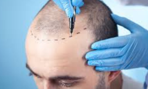 Best Hair Transplant in Hyderabad