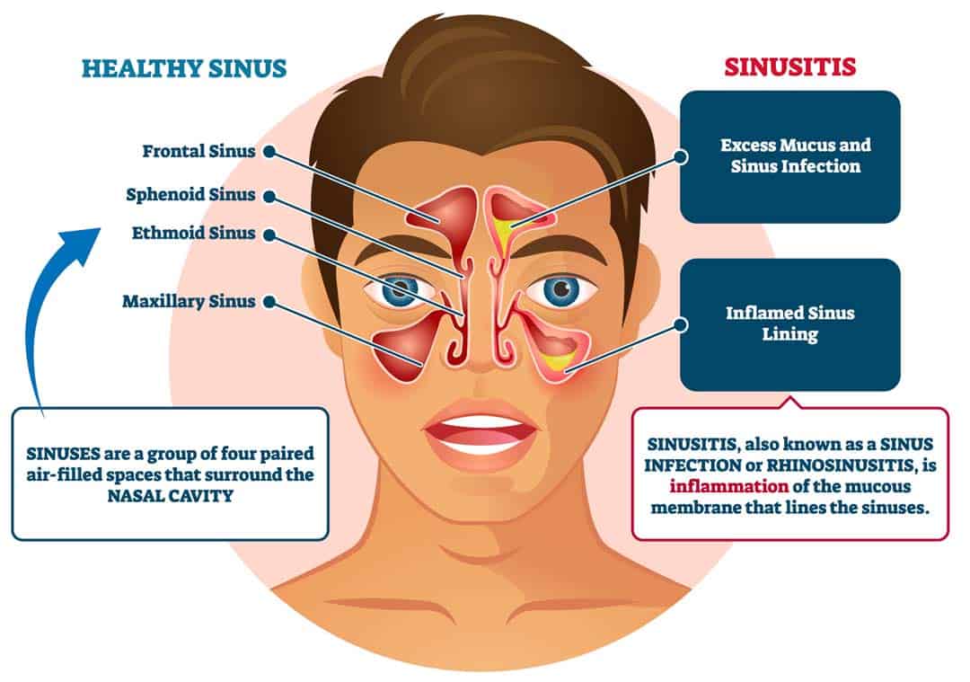 Best Sinusitis Treatment in Hyderabad