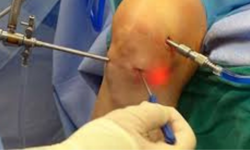 Best Arthroscopy Surgery in Hyderabad