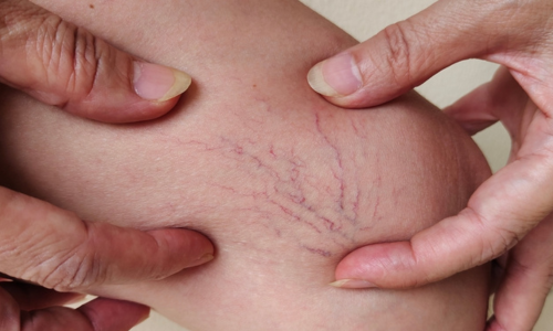 Best Varicose Veins Treatment in Hyderabad