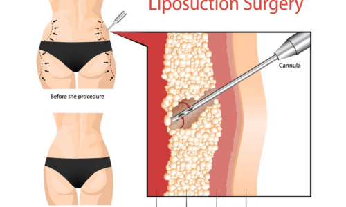 Best Liposuction Surgery in Hyderabad