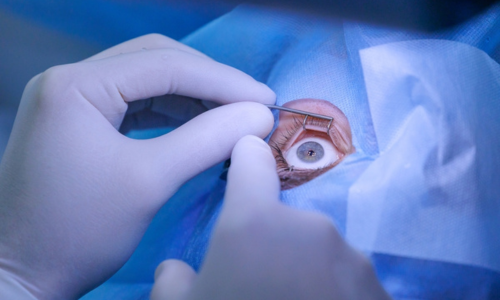 Best Cataract Treatment in Hyderabad