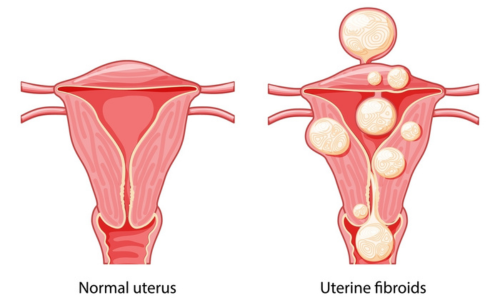 Best Uterine Fibroids Treatment in Hyderabad