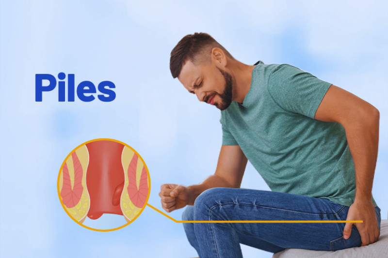 Living Pain-Free: Latest Advances in Piles (Hemorrhoids) Surgery