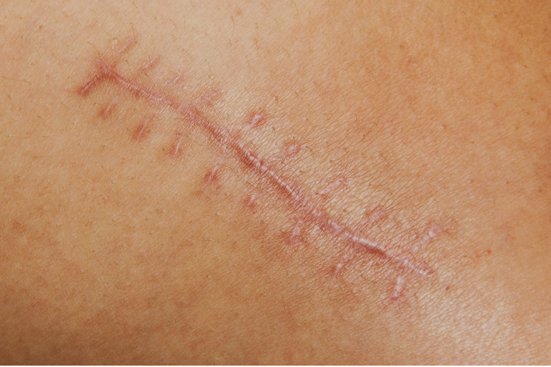 How to Care for Surgical Scars: Tips for Faster Healing & Minimal Marks