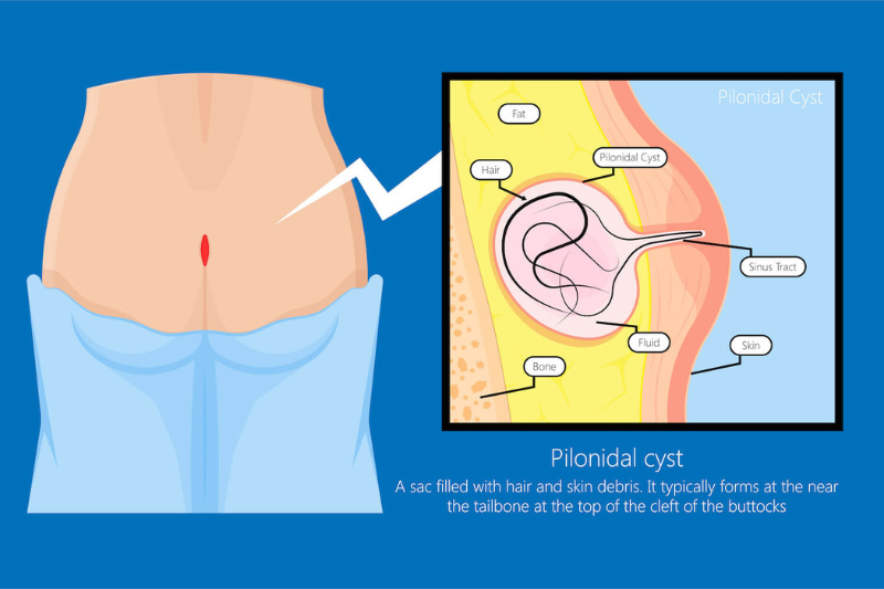 Advanced Pilonidal Sinus Treatment in Hyderabad