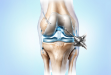 ACL tear treatment surgery of the knee joint in Hyderabad showing damaged anterior cruciate ligament repair