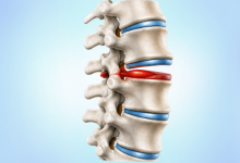 Herniated disc injury treatment in Hyderabad showing spinal disc compression and nerve pain