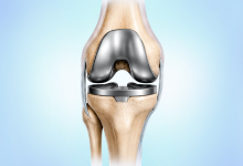 Total joint replacement surgery in Hyderabad showing artificial knee implant placement