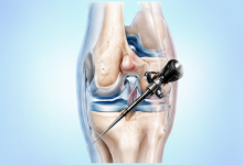 Knee arthroscopy surgery in Hyderabad using minimally invasive orthopedic techniques