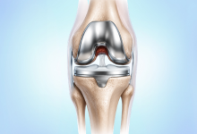 Knee replacement surgery in Hyderabad showing artificial knee implant and joint reconstruction