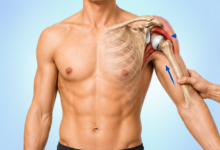 Shoulder dislocation treatment in Hyderabad showing shoulder joint repositioning procedure