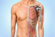 Shoulder replacement surgery in Hyderabad showing artificial shoulder joint implant