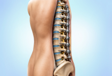 Spine surgery in Hyderabad showing spinal fixation procedure for back pain treatment