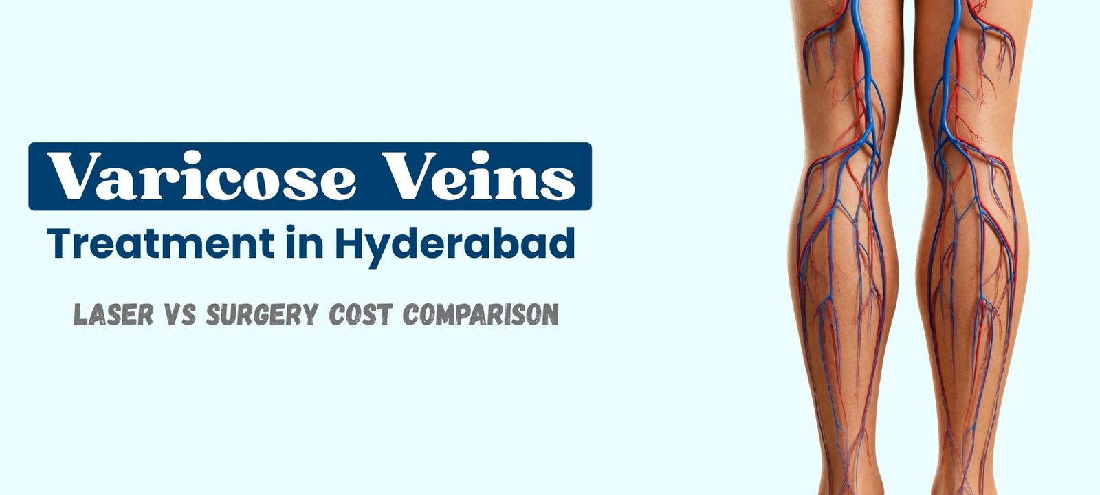 Varicose veins treatment in Hyderabad showing leg vein condition and laser treatment options