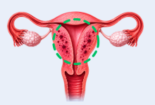 Adenomyosis treatment in Hyderabad showing enlarged uterus and abnormal growth within the uterine wall