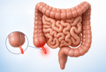 Appendectomy surgery in Hyderabad showing inflamed appendix removal treatment for appendicitis
