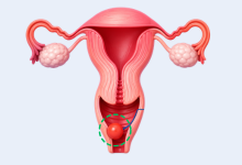 Bartholin cyst treatment in Hyderabad showing cyst near vaginal gland requiring gynecological care