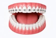 Braces and clear aligners treatment in Hyderabad for teeth straightening and smile correction