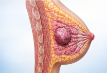 Breast lump removal surgery in Hyderabad showing breast lump diagnosis and treatment