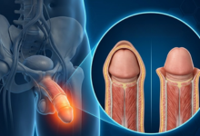 Laser circumcision treatment in Hyderabad showing foreskin condition requiring surgical correction