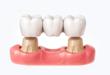 Dental crowns and bridges treatment in Hyderabad for missing tooth replacement and restoration