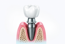 Dental implant surgery in Hyderabad showing permanent tooth replacement with titanium implant