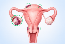 Endometriosis surgery in Hyderabad showing abnormal endometrial tissue growth affecting reproductive organs