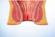Anal fissure surgery in Hyderabad showing treatment for chronic fissure and rectal pain