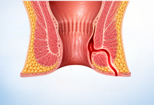 Anal fistula surgery in Hyderabad showing fistula tract treatment and laser fistula surgery