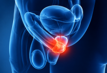 Frenuloplasty surgery in Hyderabad showing treatment for tight frenulum and penile discomfort