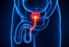 Genitourinary fistula repair surgery in Hyderabad showing urinary tract reconstruction treatment
