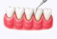 Gum surgery treatment in Hyderabad for periodontal disease and gum health restoration