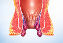 Piles treatment in Hyderabad showing hemorrhoids and advanced laser piles surgery