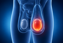 Hydrocele repair surgery in Hyderabad showing swollen scrotum treatment and fluid removal