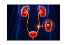 Kidney stone removal treatment in Hyderabad showing urinary tract stones and laser stone surgery