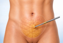Liposuction surgery in Hyderabad showing body contouring and excess fat removal treatment