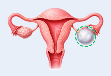 Ovarian cyst removal surgery in Hyderabad showing ovarian cyst treatment and women's healthcare