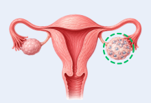 PCOS treatment in Hyderabad showing polycystic ovaries and hormonal imbalance management
