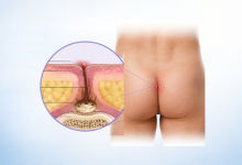 Pilonidal sinus surgery in Hyderabad showing treatment for pilonidal cyst and sinus infection