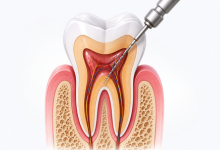 Root canal treatment in Hyderabad showing infected tooth pulp removal and tooth preservation