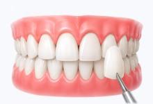 Smile design and cosmetic veneers treatment in Hyderabad for aesthetic smile makeover