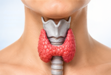 Thyroid surgery in Hyderabad showing thyroid gland treatment for thyroid disorders