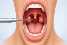 Tonsillectomy surgery in Hyderabad showing enlarged tonsil removal treatment