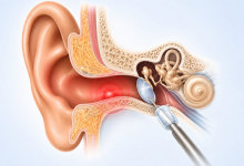 Tympanoplasty surgery in Hyderabad showing eardrum repair and hearing restoration treatment