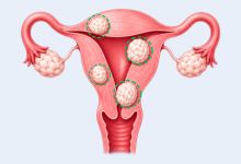 Adenomyosis treatment in Hyderabad showing enlarged uterus and abnormal growth within the uterine wall