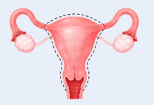 Hysterectomy surgery in Hyderabad showing uterus removal treatment for gynecological conditions