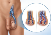 Varicocele treatment in Hyderabad showing enlarged scrotal veins and male infertility treatment