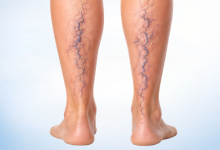 Varicose veins treatment in Hyderabad showing swollen leg veins and vascular surgery care
