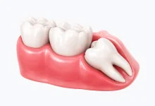 Wisdom tooth removal surgery in Hyderabad showing impacted tooth extraction treatment
